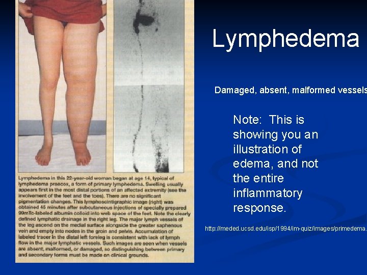 Lymphedema Damaged, absent, malformed vessels Note: This is showing you an illustration of edema, Lymphedema Damaged, absent, malformed vessels Note: This is showing you an illustration of edema,