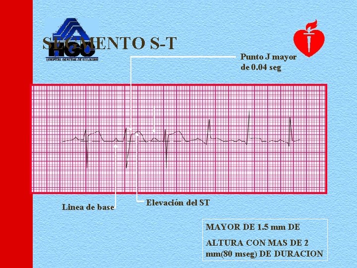 SEGMENTO S-T Linea de base Punto J mayor de 0. 04 seg Elevación del