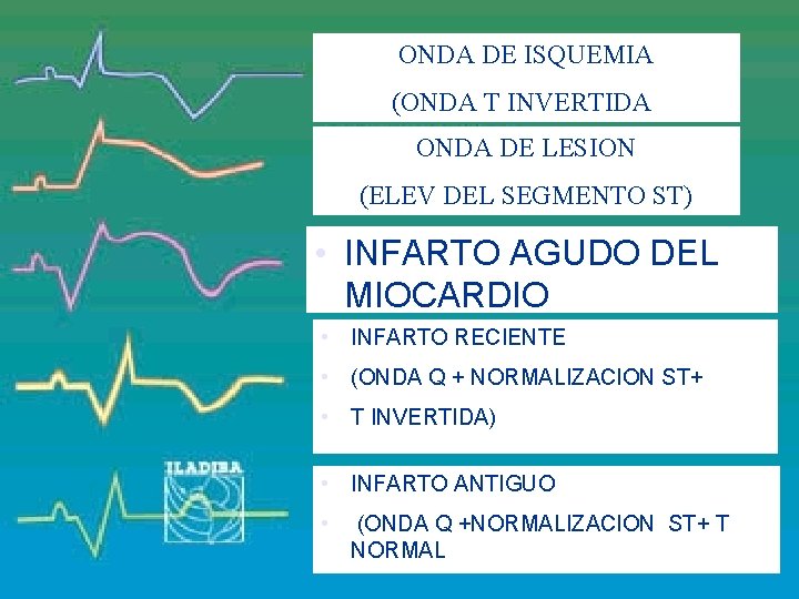 ONDA DE ISQUEMIA (ONDA T INVERTIDA) ONDA DE LESION (ELEV DEL SEGMENTO ST) •