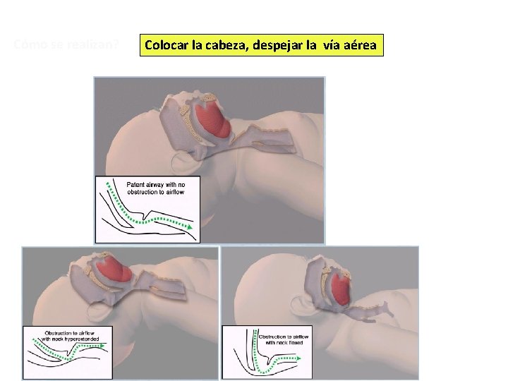 Cómo se realizan? Colocar la cabeza, despejar la vía aérea 