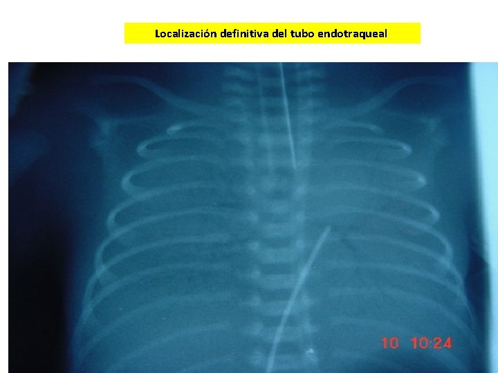 Localización definitiva del tubo endotraqueal 