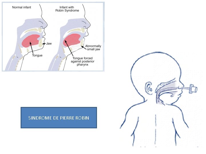 re Robin SINDROME DE PIERRE ROBIN 