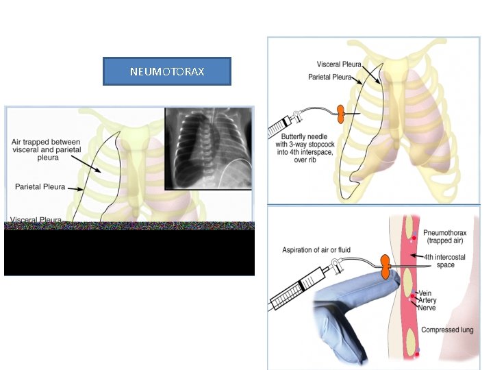 NEUMOTORAX 