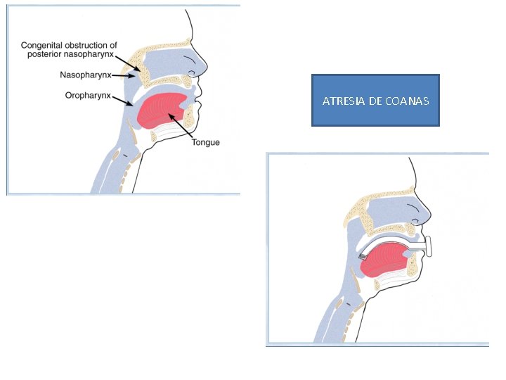 ATRESIA DE COANAS 