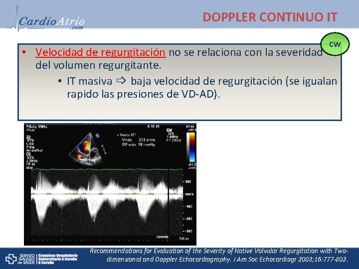 DOPPLER CONTINUO IT CW • Velocidad de regurgitación no se relaciona con la severidad
