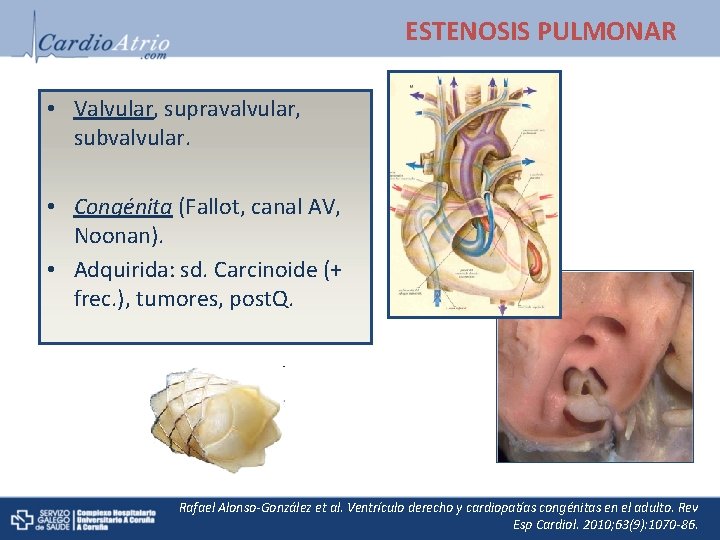 ESTENOSIS PULMONAR • Valvular, supravalvular, subvalvular. • Congénita (Fallot, canal AV, Noonan). • Adquirida:
