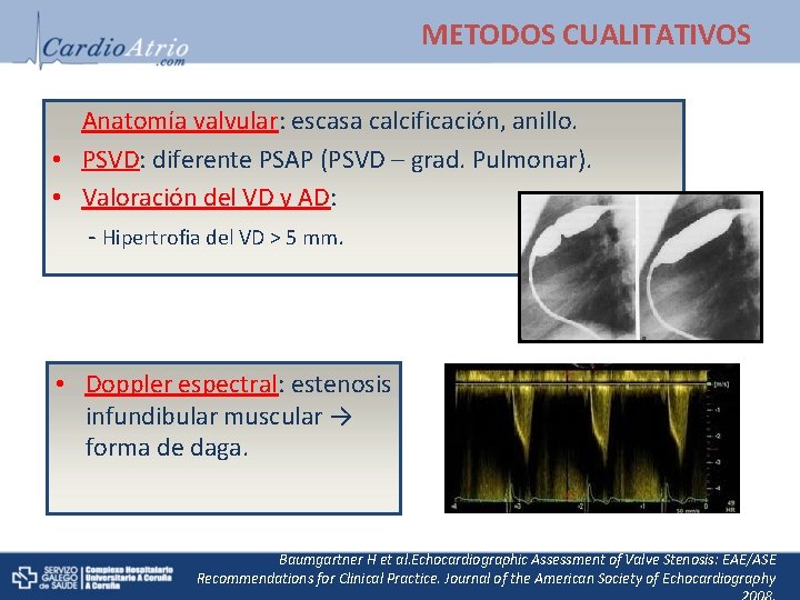 METODOS CUALITATIVOS Anatomía valvular: escasa calcificación, anillo. • PSVD: diferente PSAP (PSVD – grad.