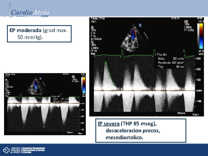EP moderada (grad max. 50 mm. Hg). IP severa (THP 85 mseg), desaceleracion precoz,