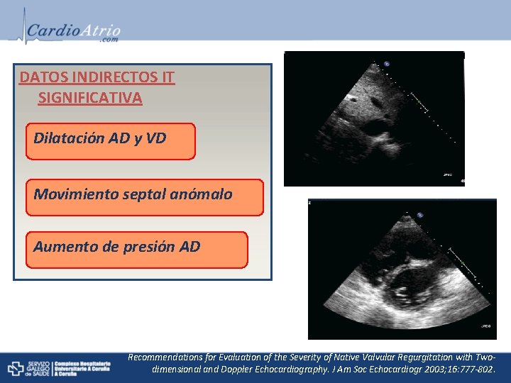 DATOS INDIRECTOS IT SIGNIFICATIVA Dilatación AD y VD Movimiento septal anómalo Aumento de presión