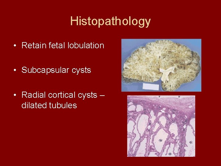 Histopathology • Retain fetal lobulation • Subcapsular cysts • Radial cortical cysts – dilated