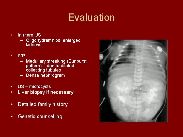 Evaluation • In utero US – Oligohydramnios, enlarged kidneys • IVP – Medullary streaking