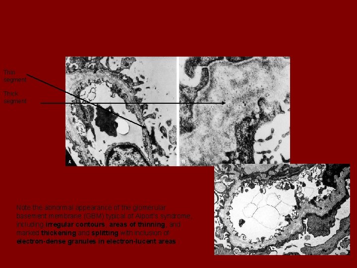 Thin segment Thick segment Note the abnormal appearance of the glomerular basement membrane (GBM)