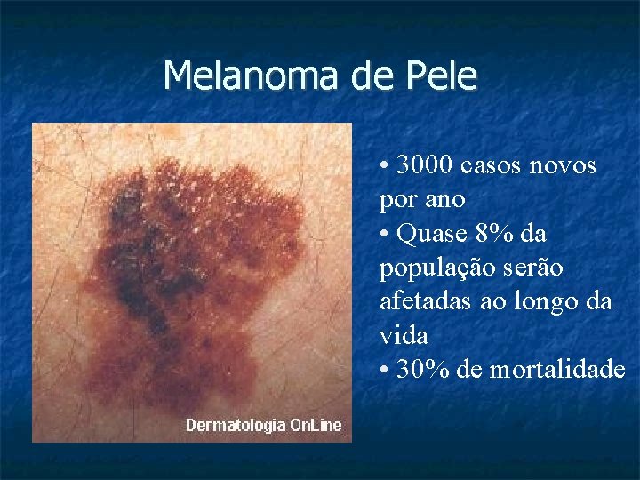 Melanoma de Pele • 3000 casos novos por ano • Quase 8% da população