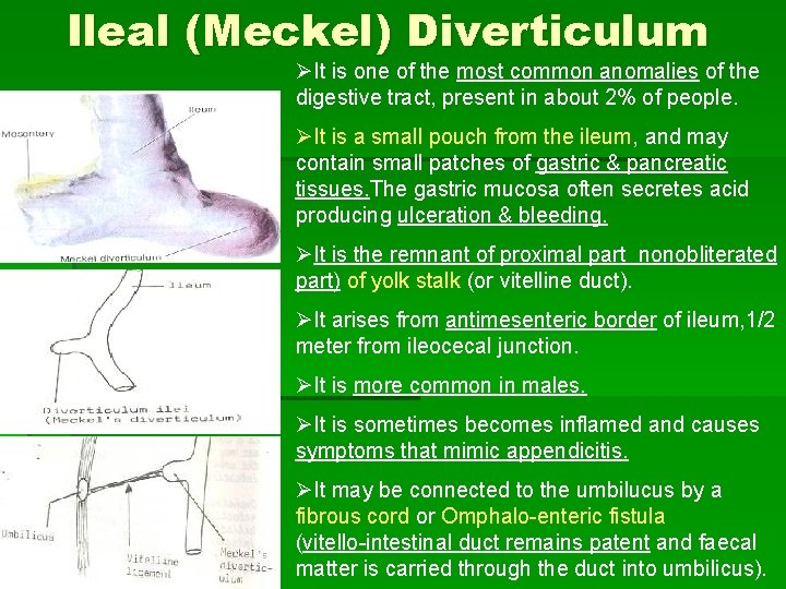 Ileal (Meckel) Diverticulum ØIt is one of the most common anomalies of the digestive
