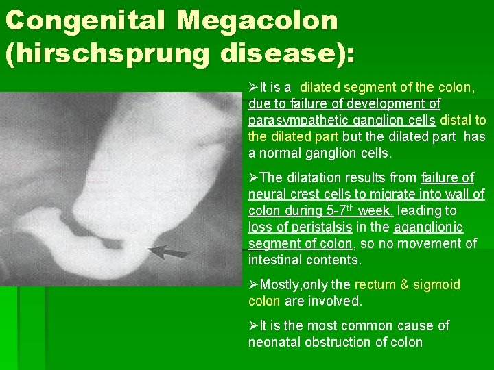 Congenital Megacolon (hirschsprung disease): ØIt is a dilated segment of the colon, due to