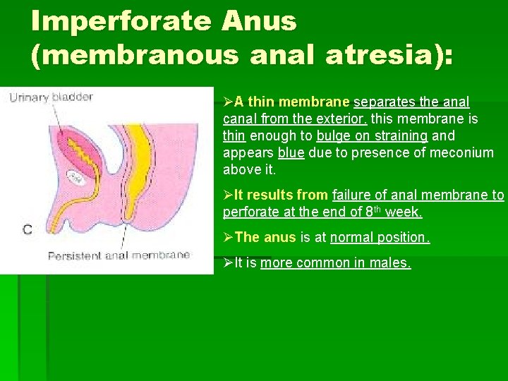 Imperforate Anus (membranous anal atresia): ØA thin membrane separates the anal canal from the