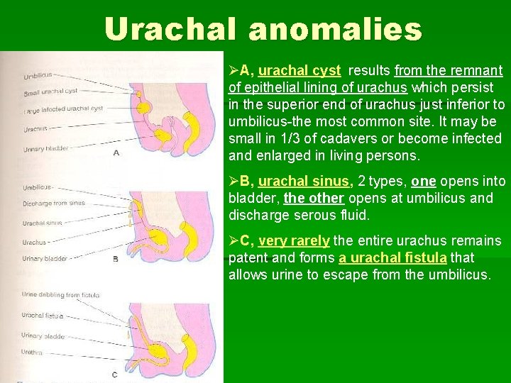 Urachal anomalies ØA, urachal cyst results from the remnant of epithelial lining of urachus