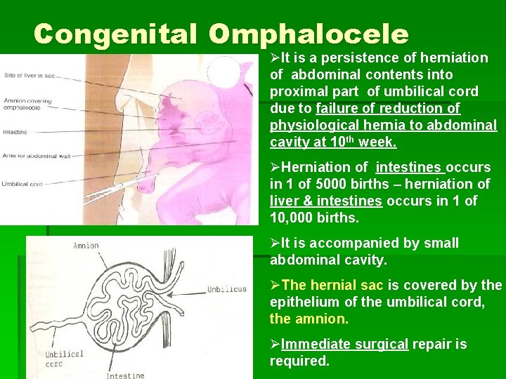 Congenital Omphalocele ØIt is a persistence of herniation of abdominal contents into proximal part