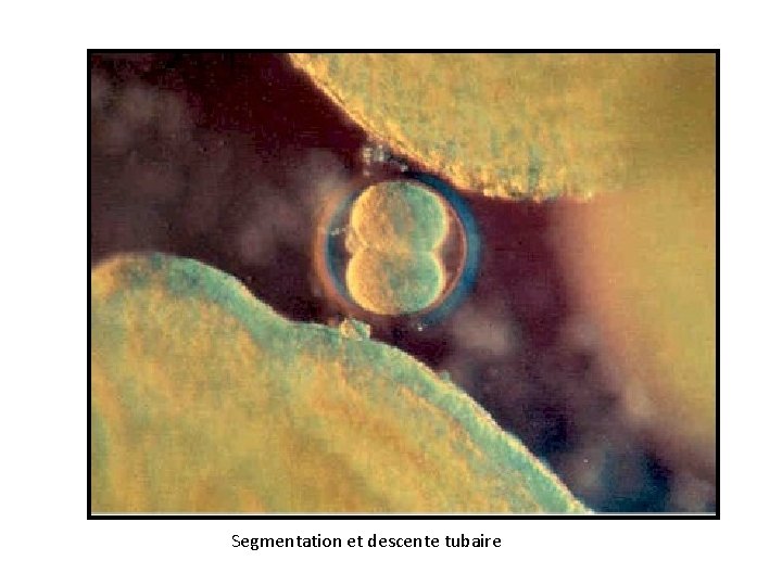 Segmentation et descente tubaire 