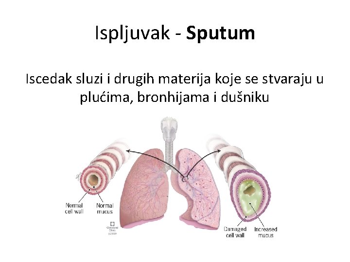 Ispljuvak - Sputum Iscedak sluzi i drugih materija koje se stvaraju u plućima, bronhijama