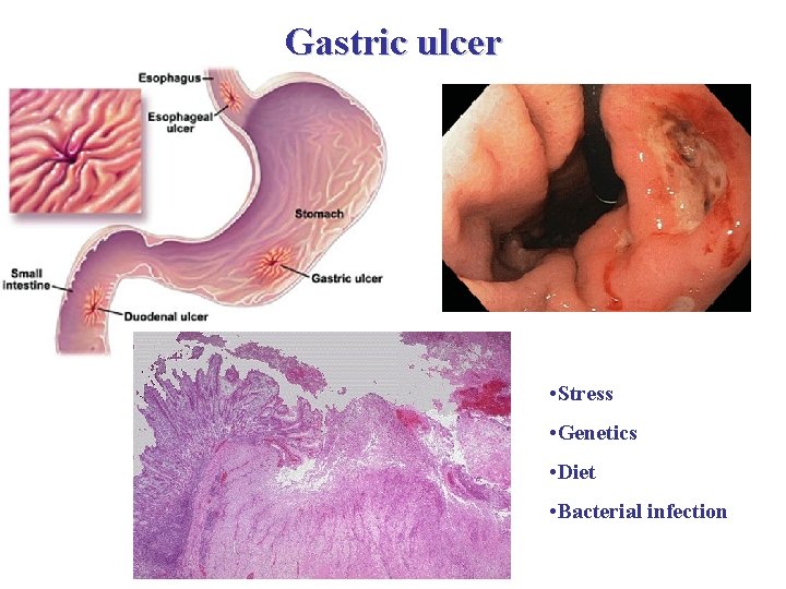 Gastric ulcer mesothel • Stress • Genetics • Diet kötőszövet • Bacterial infection 