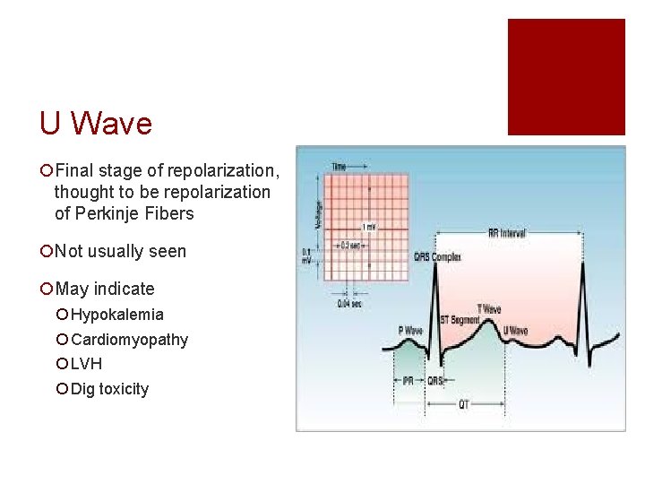 U Wave ¡Final stage of repolarization, thought to be repolarization of Perkinje Fibers ¡Not