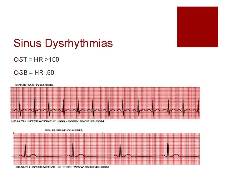 Sinus Dysrhythmias ¡ST = HR >100 ¡SB = HR , 60 