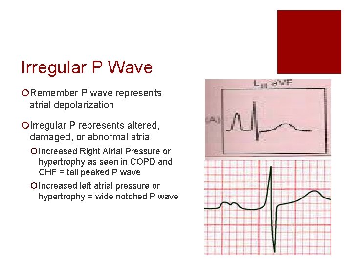 Irregular P Wave ¡Remember P wave represents atrial depolarization ¡Irregular P represents altered, damaged,