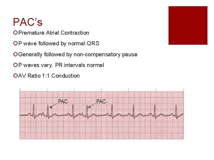 PAC’s ¡ Premature Atrial Contraction ¡ P wave followed by normal QRS ¡ Generally