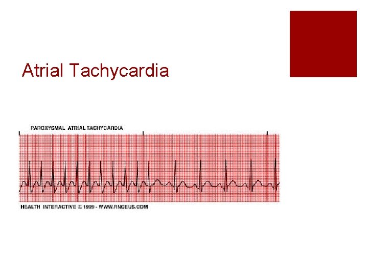 Atrial Tachycardia 