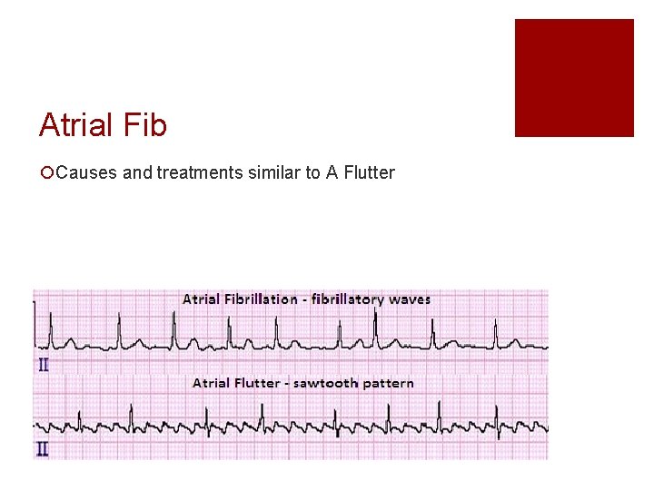 Atrial Fib ¡Causes and treatments similar to A Flutter 