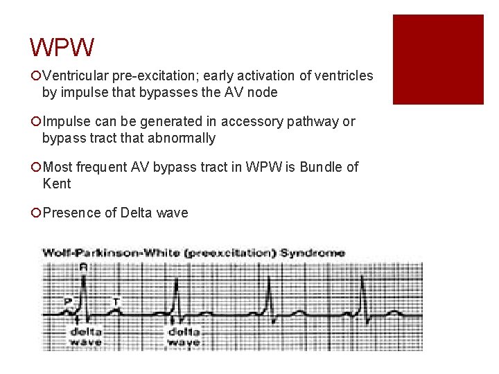 WPW ¡Ventricular pre-excitation; early activation of ventricles by impulse that bypasses the AV node