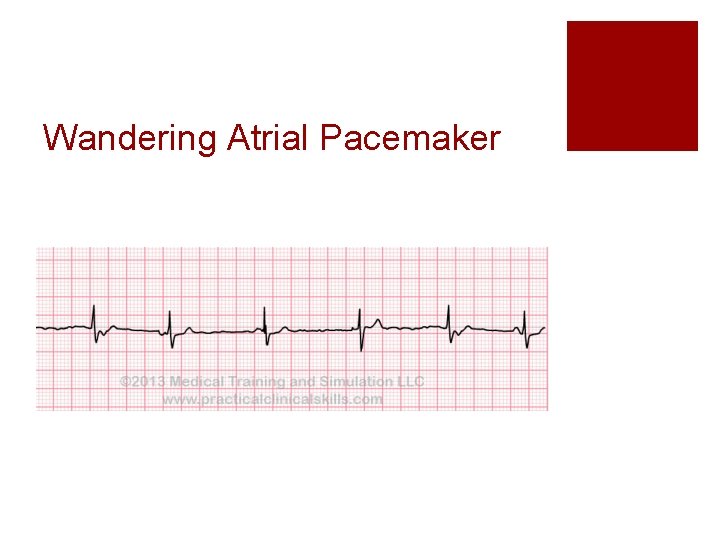 Wandering Atrial Pacemaker 