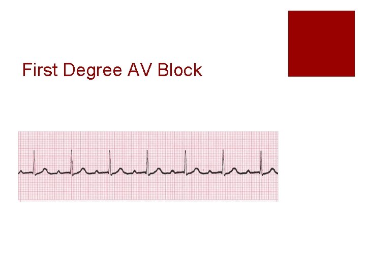 First Degree AV Block 