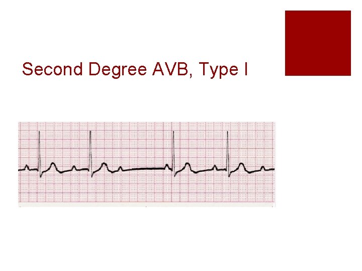 Second Degree AVB, Type I 