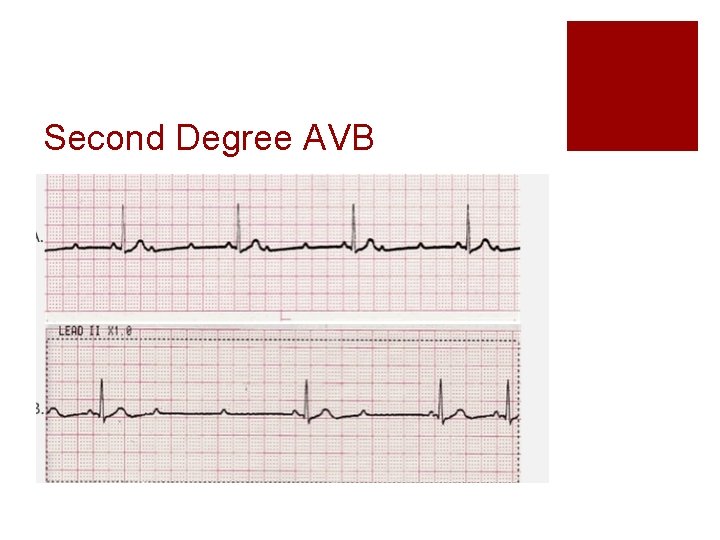 Second Degree AVB 