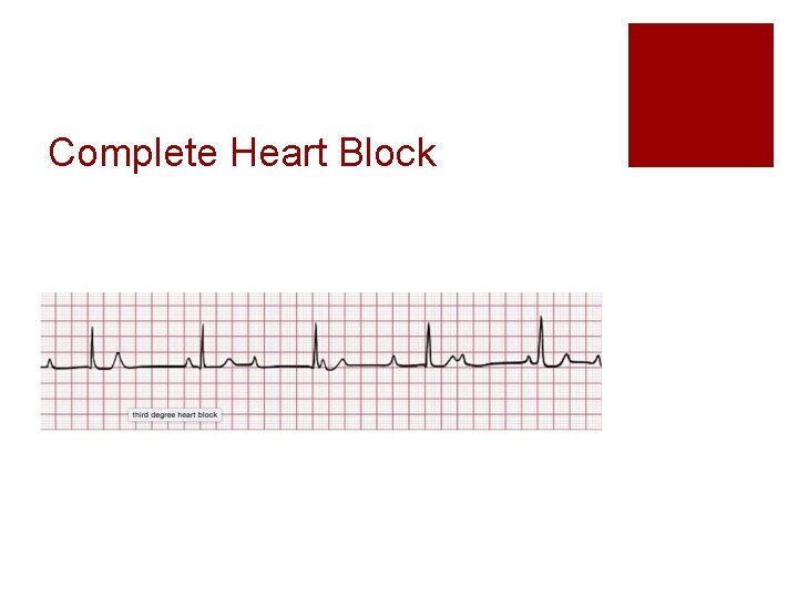 Complete Heart Block 