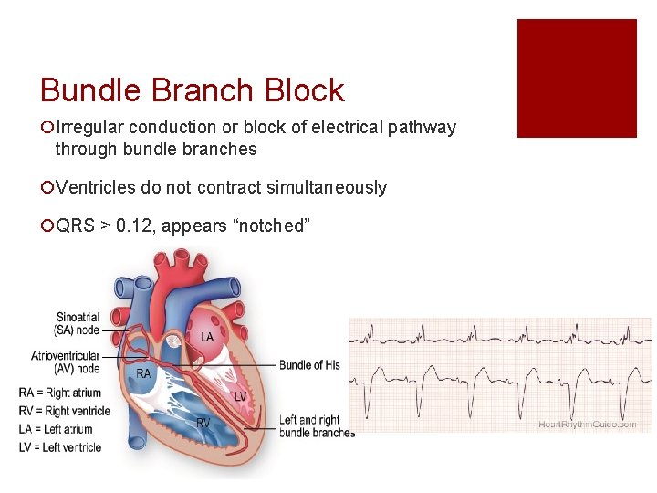 Bundle Branch Block ¡Irregular conduction or block of electrical pathway through bundle branches ¡Ventricles