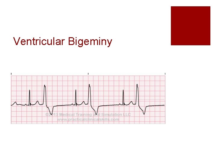 Ventricular Bigeminy 