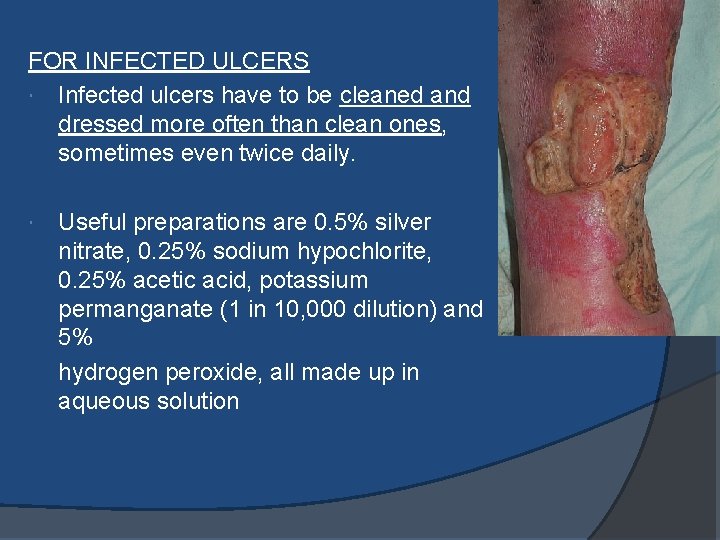 FOR INFECTED ULCERS Infected ulcers have to be cleaned and dressed more often than