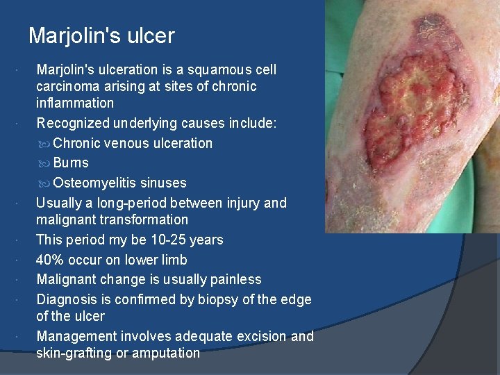 Marjolin's ulcer Marjolin's ulceration is a squamous cell carcinoma arising at sites of chronic