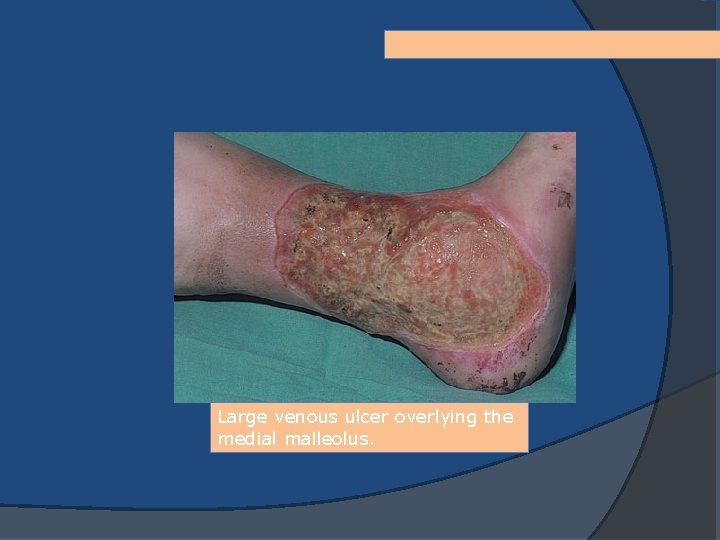 Large venous ulcer overlying the medial malleolus. 