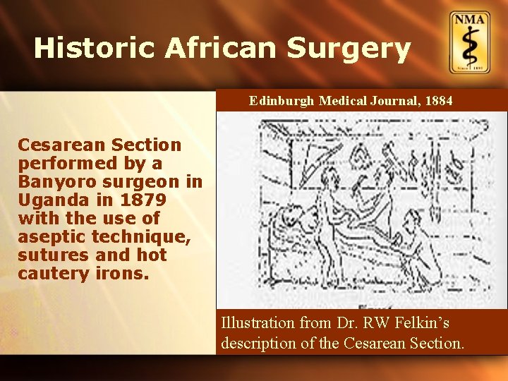 Historic African Surgery Edinburgh Medical Journal, 1884 Cesarean Section performed by a Banyoro surgeon