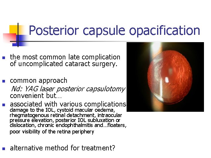 Posterior capsule opacification n the most common late complication of uncomplicated cataract surgery. n