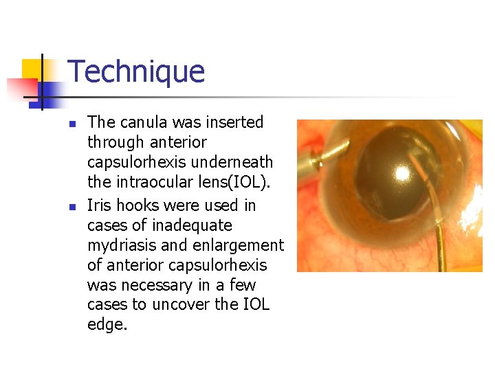 Technique n n The canula was inserted through anterior capsulorhexis underneath the intraocular lens(IOL).