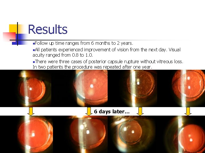 Results n. Follow up time ranges from 6 months to 2 years. n. All
