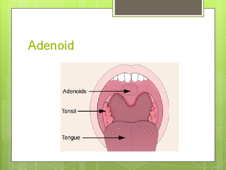 Adenoid 
