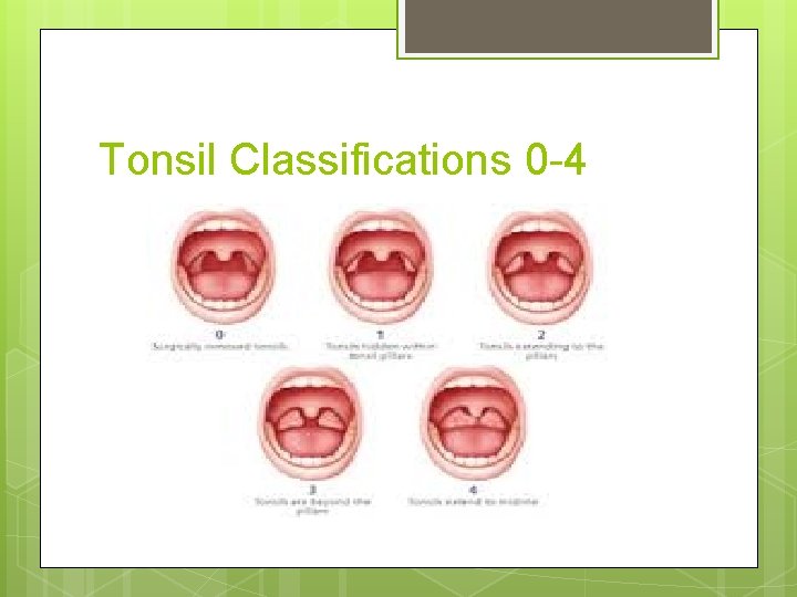 Tonsil Classifications 0 -4 