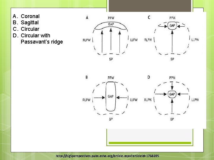 A. B. C. D. Coronal Sagittal Circular with Passavant’s ridge http: //sig 5 perspectives.
