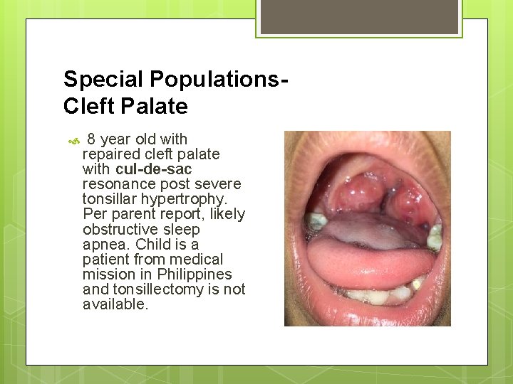 Special Populations. Cleft Palate 8 year old with repaired cleft palate with cul-de-sac resonance